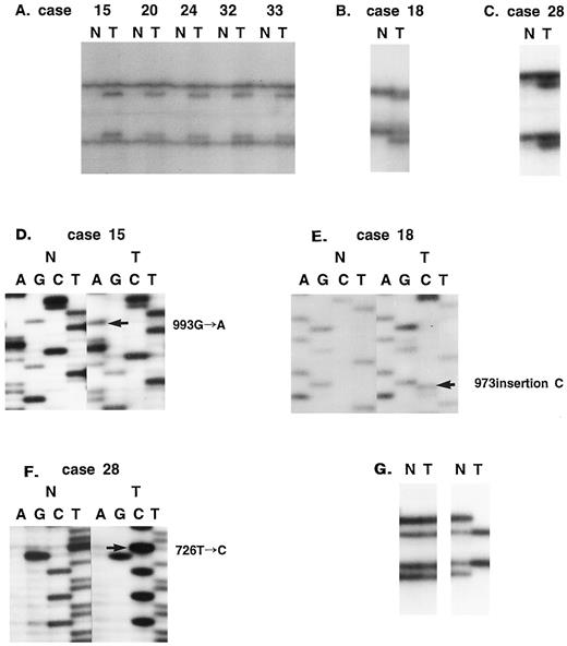 Fig. 2. Mutations and deletions of Fas gene in TCC of bladder. A–F, SSCP and sequencing analysis of DNA from tumors (Lane T) and normal tissues (Lane N) from the cases showing identical mutations in exon 9 (A and D), 1-base insertional mutation in exon 9 (B and E), and missense mutation in exon 6 (C and F). G, detection of allelic loss by amplifying a region encompassing the biallelic polymorphism, −670, in the Fas promoter. 7 Left, SSCP showing retention of heterozygosity. Right, a pattern of LOH. Loss of two bands was observed in DNA from tumor cells (T) compared with the SSCP from normal cells (N).