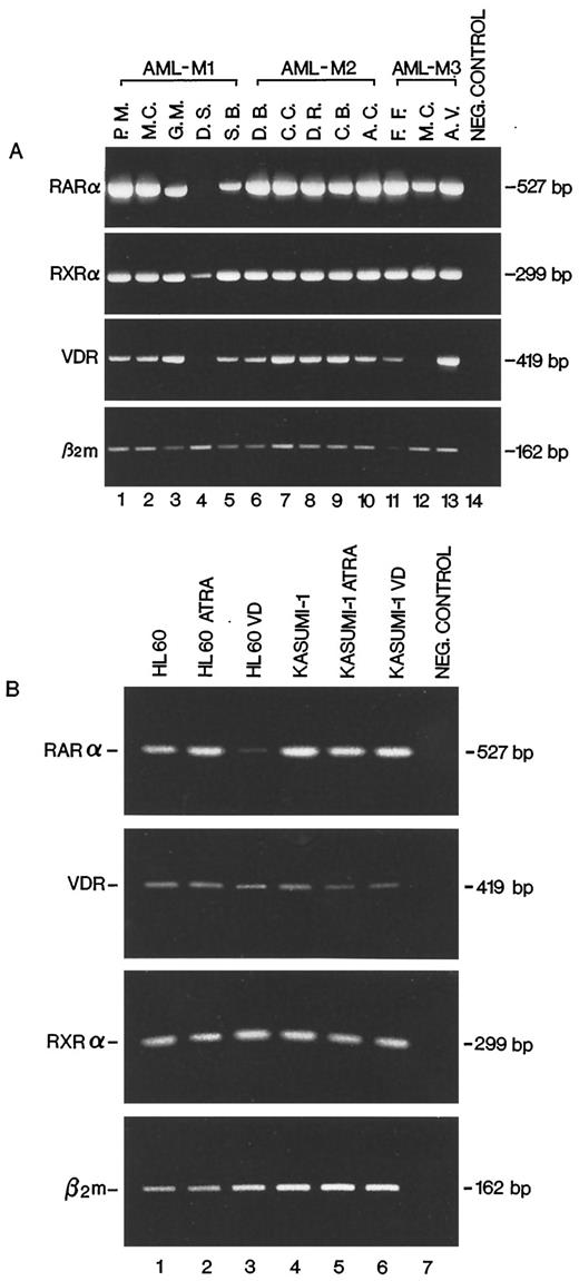 Fig. 2. Detection by RT-PCR of RARα, VDR, and RXR mRNAs in AML-M0/M1, M2, and M3 blast cell populations as well as in HL-60 and Kasumi-1 cells. Panel A: Lanes 1–5, five cases of AML-M0/M1; Lanes 6–10, five cases of AML-M2; Lanes 11–13, three cases of AML-M3; Lane 14, negative control performed without the cDNA template. Panel B: Lane 1, proliferating HL-60 cells; Lane 2, HL-60 cells treated for 12 h with ATRA; Lane 3, HL-60 cells treated for 12 h with VD; Lane 4, proliferating Kasumi-1 cells; Lane 5, Kasumi-1 cells treated for 12 h with ATRA; Lane 6, Kasumi-1 cells treated for 12 h with VD; Lane 7, negative control performed without the cDNA template. RT-PCR products of β2m mRNA are shown at the bottom of both panels. The different genes studied and the size of the amplified fragments are labeled on the left and right side of each panel, respectively.