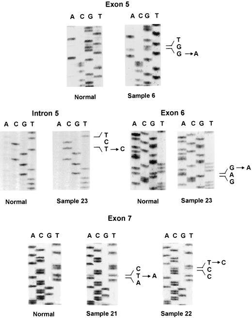 Fig. 3. Direct sequencing of exons 5, 6, and 7 of AFB1-induced microdissected lung tumor DNA. LCM sample 6 contains a G→A transition in codon 176 of exon 5. LCM sample 23 contains a T→C transition in intron 5 that is upstream of exon 6 and a silent G→A transition at codon 201 of exon 6. LCM sample 21 contains a T→A transversion in codon 248 of exon 7, whereas LCM sample 22 contains a T→C transition resulting in a silent mutation at codon 247 in exon 7. The normal sample represents DNA isolated from nontumor sample 75.