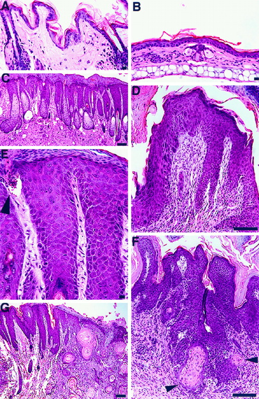 Fig. 2. Histopathology of epidermal carcinogenesis in 32-week-old K14-HPV16 transgenic mice. Both chest skin (A) and ear skin (B) from nontransgenic mice contain a thin, 4–5 cell layer epidermis. The underlying dermis is sparsely populated with fibroblasts, and inflammatory cells are absent. A hyperproliferative follicular/interfollicular dysplastic chest precursor from a transgenic mouse (C) contains enlarged hair follicles penetrating into the dermis, marked expansion of the entire ORS, and sebaceous gland hypertrophy. A high-power view of hair follicles from a chest precursor containing numerous dysplastic ORS keratinocytes, marked parakeratosis, and microulceration (E, arrowhead) is shown. In the ear, precursors are protuberant papillomas with high-grade dysplasia and carcinoma in situ (D). Microinvasive cancers develop directly from precursor lesions in the ear (F, arrowheads) and chest (G). Bars: A, B, and E, 10 μm; C, D, F, and G, 100 μm.