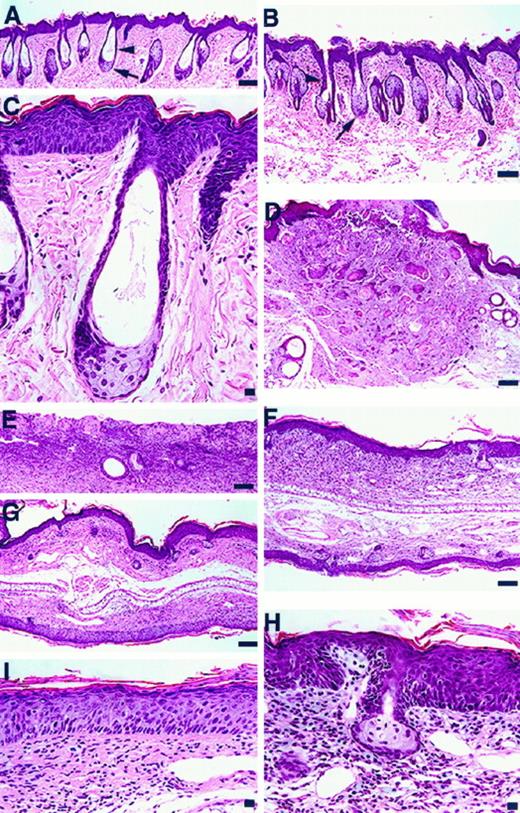 Fig. 3. Effect of DFMO chemoprevention on chest and ear skin of transgenic mice. Histopathological response of chest (A, C, and E) and ear (G and I) skin to DFMO chemoprevention from 4 to 32 and 28 to 32 (B and D, chest; F and H, ear) weeks of age. In the chest, DFMO eliminated hyperplasia of the hair follicle ORS (A, arrowhead) and diminishing hypertrophy of the sebaceous glands by apparent cystic degeneration (A, arrow). A high-power view of a hair follicle from a DFMO-treated mouse demonstrates cystic destruction of the sebaceous glands, enlargement of the ORS limited to the upper third of the follicle, and persistent interfollicular dysplasia (C). In chest ulcers, DFMO induced cystic changes in isolated hair follicle elements (E). DFMO chemoprevention prevented papilloma formation in the ear and reduced dermal inflammatory cell infiltration (G and I) but did not diminish the severity or frequency of dysplastic foci in transgenic mice (I). DFMO treatment from 28 to 32 weeks, late-stage treatment, diminished but did not eliminate ORS hyperplasia (B, arrowhead) or sebaceous gland hypertrophy (B, arrow) in the chest. Microscopic cancer was also still detectable in late-stage treated transgenic mice (D). In the ear, the incidence of papillomas was markedly reduced by late-stage therapy (F), but dermal inflammatory infiltration (F and H) and dysplasia were persistent and unaffected by therapy (H). Bars: A, B, D, E, and G, 100 μm; C, H, and I, 10 μm.
