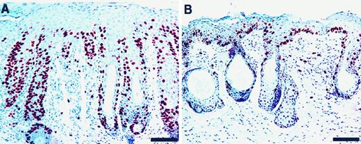 Fig. 5. Immunohistochemical analysis of S-phase keratinocytes untreated and DFMO-treated chest skin precursors. A hyperproliferative follicular/interfollicular dysplastic chest precursor from an untreated 32-week-old transgenic mouse is composed of ORSs filled with BrdUrd-positive cells (A). DFMO chemoprevention markedly reduced the frequency of BrdUrd-positive keratinocytes in chest skin, particularly in the hair follicle ORS (B). Bars, 100 μm.