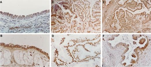 Fig. 1. p27Kip1 immunostaining in normal ovarian surface epithelium and LMP ovarian tumors. A and B, p27 expression in two normal ovaries was detected in the nucleus as well as in the cytoplasm of ovarian surface epithelium and stromal cells (magnification, ×250). C-F, p27 immunostaining in two LMP tumors. p27 is highly expressed and mostly nuclear in one case (C and D) and shows concomitant cytoplasmic staining in another case (E and F). Magnification, ×150 (C and E) and ×250 (D and F).