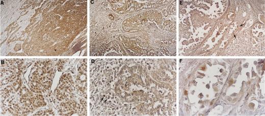 Fig. 2. p27Kip1 immunostaining in three representative cases of primary ovarian adenocarcinomas. A and B, p27 is expressed in 90% of the neoplastic cells, which show a strong, positive staining of the nuclei and a diffuse, faint cytoplasmic staining. Magnification, ×150 (A) and ×250 (B). C and D, decreased p27 staining in 50% of neoplastic cells with mostly exclusive cytoplasmic staining of tumor cells and strong nuclear staining in lymphocytes (arrows). Magnification, ×150 (C) and ×250 (D). E and F, in contrast, focal staining for p27 is seen in this specimen (arrows). Magnification, ×150 (E) and ×400 (F).