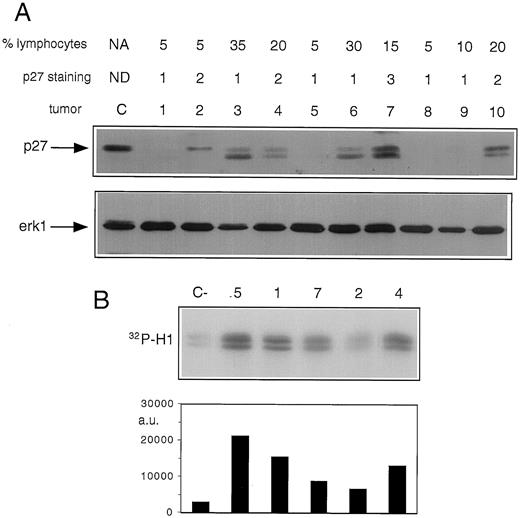 Fig. 4. A, p27 differential expression in primary ovarian carcinomas was assayed by Western blot. B, Cdk2 immunoprecipitates from the same primary tumor lysates were assayed for associated histone H1 kinase activity. Radioactivity in histone H1 bands is shown. When p27 staining was low in tumor cells, cdk2 activity was high. In contrast, tumors with high p27 staining showed low kinase activity.
