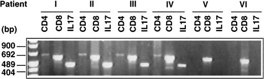 Fig. 7. IL-17 mRNA expression in biopsies derived from invasive cervical carcinomas. Six cDNAs derived from mRNA extracted from six primary invasive cervical carcinomas were amplified by PCR using oligonucleotide primers specific for hIL-17, CD4, and CD8. Amplified PCR products were loaded onto a 2% agarose gel and stained with ethidium bromide for UV visualization.