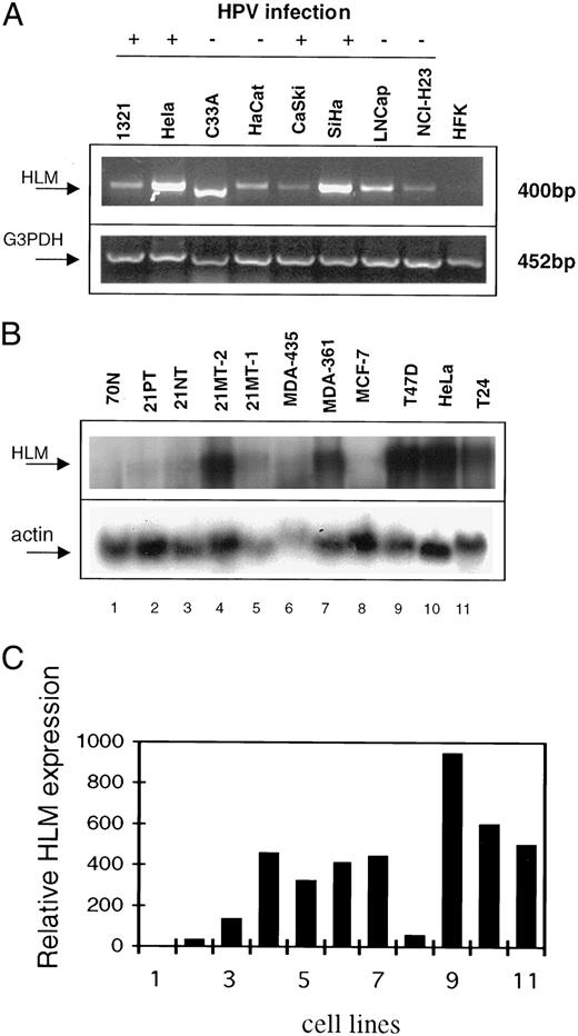 Fig. 3. HLM is expressed in several cancer cell lines. A, ethidium bromide-stained gel of RT-PCR products generated using HLM- and G3PDH-specific primers in multiple cancer cell lines. 1321, HPV E6/E7 immortalized keratinocytes; HaCat, spontaneously immortalized keratinocytes; HeLa, C33A, CaSki, and SiHa, cervical cancer; LNCap, prostate cancer; NCI-H23, lung cancer; HFK, primary human keratinocytes; +, HPV-positive; −, HPV-negative. B, Northern blot analysis of multiple cancer cell lines. 70N and 21T series are derived from normal mammary epithelial cells and mammary carcinoma cells, respectively. 21PT and 21NT cells were derived from a primary tumor, whereas 21 MT-2 and 21 MT-1 were established from pleural effusion from the same patient (20). MDA-435, MDA-361, T47D, and MCF-7, breast cancer; HeLa, cervical cancer; T24, bladder cancer. C, quantitative representation of HLM expression in the cell lines on B after normalization to actin (Lanes 1–11).