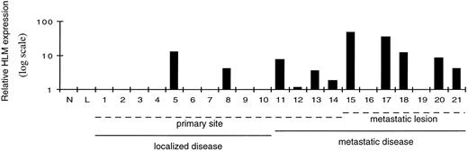 Fig. 5. HLM relative expression in breast cancer tumor samples is associated with metastasis. Quantitative representation of a Northern blot analysis of: normal adjacent breast tissue and normal luminal cells (Lanes N and L, respectively); 10 tumor biopsy samples from patients with localized disease (Lanes 1–10); 11 tumor biopsy samples from metastatic disease patients, including 4 primary sites (Lanes 11–14) and 7 metastatic lesions (Lanes 15–21). The blot was stripped and reprobed with 36B4 (22) for normalization, and relative expression was plotted.