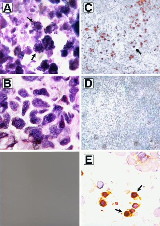 Fig. 10. Histological and TUNEL staining of human NB xenograft tumors. Tumors were surgically removed 24 h after injection of a single i.v. dose of anti-NB IgM. Shown are H&E-stained NB tumor sections from xenografts in nude rats with (A) and without (B) anti-NB IgM treatment. Arrows, apoptotic cells (A). TUNEL staining was performed of NB tumor sections from an anti-NB IgM-treated tumor (C) and an untreated control tumor (D). E, a TUNEL-stained cytospin preparation from a disintegrated tumor section from an anti-NB IgM-treated animal. TUNEL-positive cells (arrows) show a dark brown color (C–E). A, B, and D, ×1000; C and E, ×200.