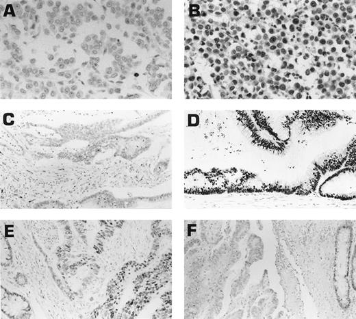 Fig. 1. Immunohistochemical analysis of hMLH1 and hMSH2 expression in three carcinomas from unrelated HNPCC patients. A–B, mammary tumor staining negative for hMLH1 (A) and positive for hMSH2 (B); C–D, colonic tumor staining negative for hMLH1 (C) and positive for hMSH2 (D); E–F, colonic tumor staining positive for hMLH1 (E) and negative for hMSH2 (F). In F, a positive-staining normal colonic crypt (to the right) serves as an internal positive control.