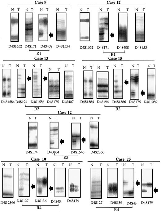 Fig. 3. Representative autoradiographs for cases with discrete allelic loss at chromosome 4 demonstrating loss and retention of neighboring alleles in noncultured breast carcinomas. Het, retention of heterozygosity; Ni, noninformative. Case 9 (D4S1652-Het, D4S171-Ni, D4S408-LOH, D4S1554-Het) and case 12 (D4S1652-Het, D4S171-LOH, D4S408-Ni, D4S1554-Het) define the region R1 between D4S408 and D4S171. Case 13 (D4S1584-Het, D4S194-LOH, D4S1586-LOH, D4S175-Ni, D4S407-Het) and case 15 (D4S1584-Het, D4S194-Ni, D4S1586-LOH, D4S175-LOH, D4S1089-Het) define the region R2 between D4S175 and D4S194. Case 12 (D4S174-Het, D4S404-LOH, D4S1586-LOH, D4S2366-Het) defines region R3 between D4S174 and D4S2366. Case 10 (D4S2366-Het, D4S127-LOH, D4S136-LOH, D4S43-Ni, D4S179-Het) and case 25 (D4S127-Het, D4S136-Ni, D4S43-LOH, D4S179-LOH) define the region R4 between D4S43 and D4S127. N, normal; T, tumor. DNAs were assayed as described in “Materials and Methods” using the microsatellite markers indicated. Arrowheads, LOH.