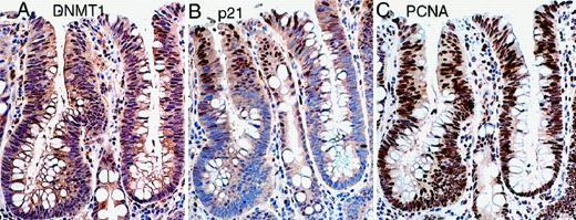 Fig. 4. Immunohistochemical staining for DNMT1, PCNA, and p21 in colonic adenoma tissue. Compared with normal colonic epithelium (see Fig. 3<$REFLINK>), an increased fraction of cells expressed DNMT1 and PCNA. In addition, some DNMT1-expressing cells also appeared to contain p21.
