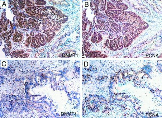 Fig. 5. Immunohistochemical staining for DNMT1 and PCNA in colonic carcinoma tissue. Carcinoma cells expressing very high and very low levels of DNMT1 and PCNA were evident. (A and B) and (C and D), two different regions of the same carcinoma.