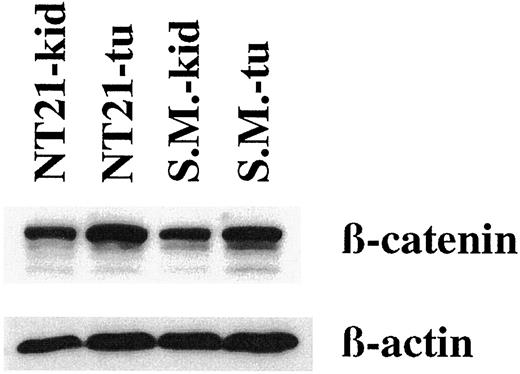 Fig. 3. Western blot analysis of tumor (tu) and normal kidney (kid)-derived tissue lysates from patients NT21 and S.M. using monoclonal antibodies specific for β-catenin and β-actin. Both tumors bear a mutated β-catenin gene.