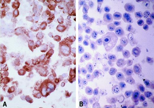 Fig. 2. PTEN expression in prostate cancer cell lines. Sections of cell blocks prepared from (A) DU145 cells (which contain one wild-type PTEN allele) or (B) PC-3 cells (which show a homozygous deletion of PTEN) were stained with M1 antiserum as described in “Materials and Methods.” ×400.