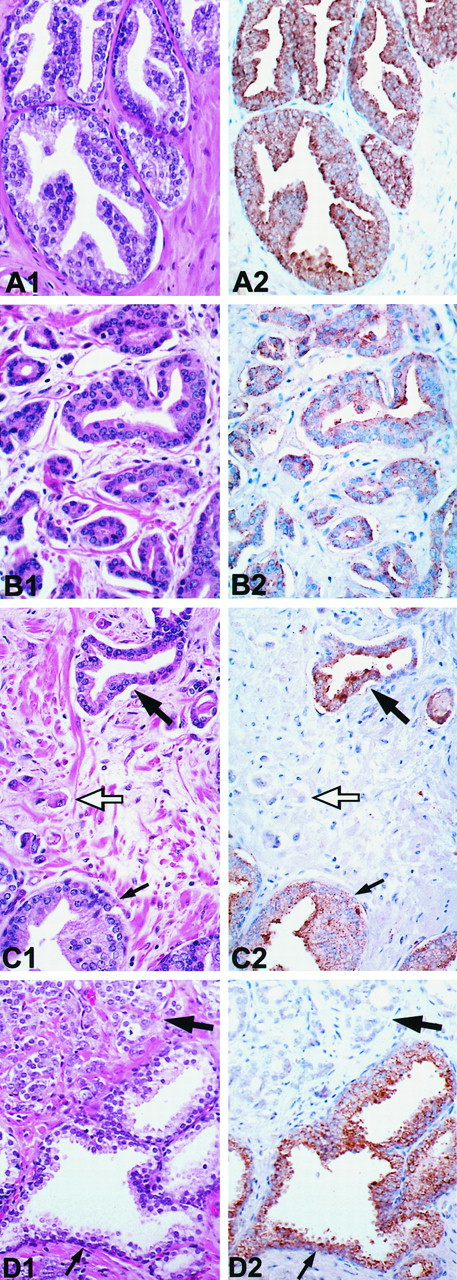 Fig. 3. PTEN expression in prostate tissue. A, PIN. A1, H&E-stained section of PIN. A2, positive staining for PTEN in PIN. B, prostate cancer (Gleason score, 3 + 3 = 6). B1, H&E-stained section. B2, positive staining for PTEN in prostate cancer. C, an example of heterogeneous expression of PTEN in a case of prostate cancer (Gleason score, 3 + 5 = 8). C1, prostate cancer. Gleason grade 3 cancer (large black arrow), Gleason grade 5 cancer (open arrow), and PIN (short black arrow). H&E-stained section. C2, Gleason grade 3 prostate cancer stains positively for PTEN (see large black arrow). In contrast, Gleason grade 5 prostatic carcinoma is negative for PTEN expression (open arrow). PIN shows positive staining for PTEN (short black arrow). D, benign prostate acinus with surrounding prostate cancer (Gleason score, 4 + 3 = 7). D1, H&E-stained section. Small arrow, benign prostatic glandular epithelium; large arrow, prostatic adenocarcinoma). D2, positive staining for PTEN in benign prostate tissue and absence of staining for PTEN in prostate cancer. ×200. All tissue sections were processed as described in “Materials and Methods.”