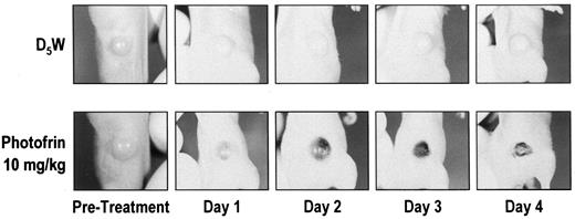 Fig. 2. Time course of gross tumor response to PDT. A673 human tumors were grown in nude mice up to a size of ∼10 mm in diameter. Photofrin II (10 mg/kg) dissolved in 5% dextrose was injected by tail vein, and the tumors were exposed to light of 630 nm at 100 J/cm2 exactly 24 h later. Upper panel, response of control tumors injected with 5% dextrose; lower panel, response of Photofrin II-injected tumors. The PDT-treated tumors appear dusky 3–6h after light treatment and progressed to eschar over the course of 2–4 days.