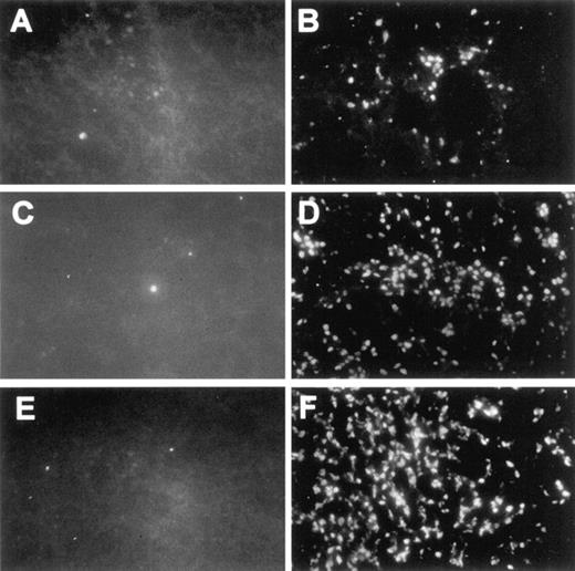 Fig. 7. Photomicrographs of control (left panels) and PDT-treated (right panels) of cryopreserved tumor sections labeled for apoptosis using the TUNEL assay. Tissue sections of control tumors at 4, 18, and 36 h (A, C, and E, respectively) show little or no apoptotic cells. PDT-treated tumor sections at 4, 18, and 36 h (B, D, and F, respectively) show a progressively increasing number of apoptotic cells with increasing time after PDT.