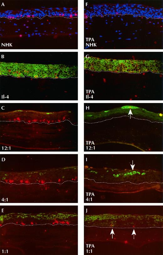 Fig. 3. TPA induces clonal expansion and proliferation of II-4 cells in 12:1 and 4:1 mixtures, which is associated with the decreased proliferation of NHKs. Double immunofluorescence stain demonstrating superimposed fluorescent signals for β-gal (FITC channel, green) and BrdUrd (Texas red channel, red). A, NHK cultures grown without TPA, demonstrating BrdUrd-positive nuclei limited to the basal layer and no β-gal expression. All nuclei counterstained with 4′,6-diamidino-2-phenylindole, blue channel. B, pure II-4 cell cultures grown without TPA, demonstrating that all II-4 cells express β-gal and the presence of BrdUrd-positive nuclei in basal and suprabasal layers. C, mixture of NHK:II-4 cells (12:1), demonstrating individual β-gal cells in a suprabasal position and BrdUrd-positive nuclei limited to the normal basal keratinocytes. Individual β-gal cells lack colocalization of β-gal and BrdUrd, demonstrating withdrawal of II-4 cells from the cell cycle in the absence of TPA. D, mixture of NHK:II-4 cells (4:1), demonstrating individual β-gal cells in a suprabasal position and BrdUrd-positive nuclei limited to the normal basal keratinocytes. E, mixture of NHK:II-4 (1:1), showing large β-gal-positive II-4 cell clusters and BrdUrd-positive nuclei limited to the normal basal keratinocytes. F, NHK cultures grown with 0.001 μg/ml TPA, demonstrating decreased numbers of BrdUrd-positive nuclei limited to the basal layer and no β-gal expression. G, pure II-4 cell cultures grown with 0.001 μg/ml TPA, demonstrating continued proliferation as evidenced by presence of BrdUrd-positive nuclei in all strata. H, mixture of NHK:II-4 cells grown with 0.001 μg/ml TPA, demonstrating increased size of β-gal-positive II-4 cells. Note positive cell cluster, which is also BrdUrd-positive (arrow), as seen by the yellow nucleus and green cytoplasm (arrow) in the center of an expanding cluster. I, mixture of NHK:II-4 (4:1) grown with 0.001 μg/ml TPA, demonstrating increased numbers of β-gal-positive II-4 cells (arrow). J, mixture of normal keratinocytes:II-4 (1:1), showing large clusters of β-gal cells, an occasional BrdUrd-positive NHK nucleus (dotted arrow), and a BrdUrd-positive II-4 cell nucleus (solid arrow). White dotted line, the dermal-epithelial interface.