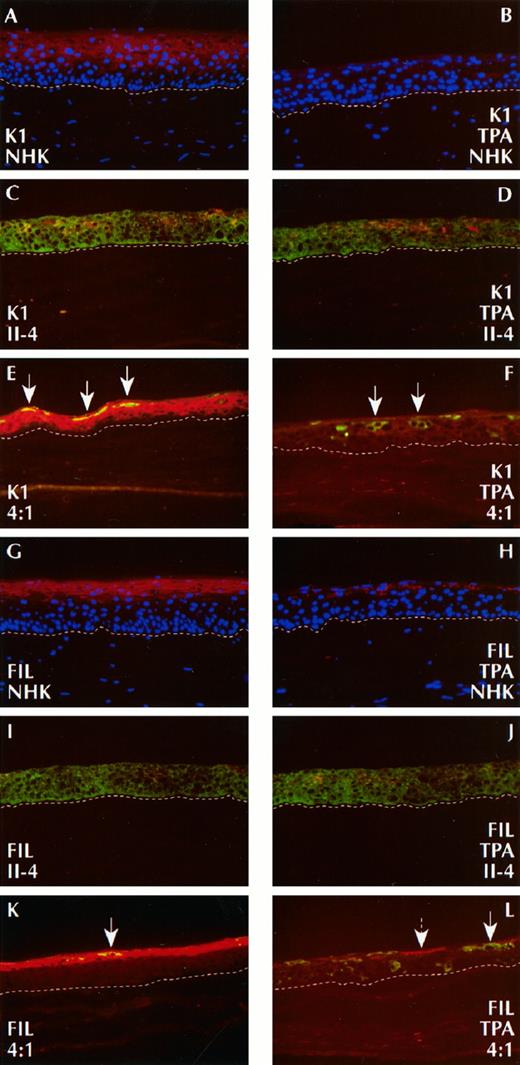 Fig. 9. Double immunofluorescence stain of organotypic cultures for β-gal and either K1 or FIL after TPA exposure. Superimposed immunofluorescence signals for β-gal (FITC channel, green) and K1 or FIL (Texas red channel, red). Normal keratinocytes were stained for K1, with (B) and without (A) TPA, and demonstrated the complete loss of K1 expression in the presence of TPA. II-4 cells stained for K1, with (D) and without (C) TPA showed no difference in expression. Mixtures (4:1; NHK:RII) treated with TPA demonstrated the complete loss of K1 expression (F) and the expansion of II-4 cells (F, arrows), whereas 4:1 mixtures not treated with TPA coexpressed K1 and β-gal in II-4 cells (E, yellow cells, arrows) and K1 in keratinocytes adjacent to them. Normal keratinocytes stained for expression of FIL after culture with (H) and without (G) TPA showed a decrease in FIL in the presence of TPA. II-4 cells stained for FIL, with (J) and without (I) TPA, showed a similar staining pattern. Mixtures (4:1; NHK:RII) treated with TPA demonstrated patchy FIL expression in the upper strata (L, broken arrow) and the expansion of II-4 cells (L, solid arrow), whereas 4:1 mixtures not treated with TPA demonstrated coexpression of FIL and β-gal in II-4 cells (K, arrow).