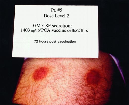 Fig. 1. Vaccine site appearance 72 h after inoculation of irradiated autologous GM-CSF-secreting PCA cells. Pt, patient.