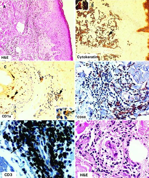 Fig. 2. Vaccine site biopsy photomicrographs showing skin infiltration by immune effector cells 72 h after vaccination. Immunohistochemical staining for various antigens was accomplished as described in “Materials and Methods.” A, inflammatory cell infiltrates apparent after H&E staining; B, cytokeratin-positive vaccine cells; C, CD1a-positive DCs in the epithelium and dermis; D, CD68-positive macrophages; E, CD3-positive T-cells; F, eosinophils, neutrophils, and other mononuclear inflammatory cells evident after H&E staining.