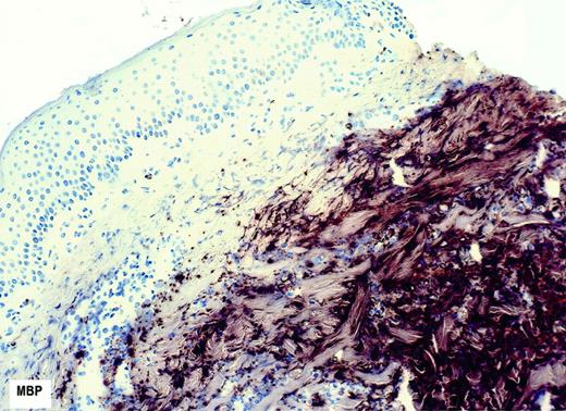 Fig. 3. Eosinophil degranulation at the vaccine site. Vaccine site biopsy obtained 72 h after vaccine inoculation was stained for eosinophil major basic protein (MBP) using an immunohistochemical technique (see “Materials and Methods”).