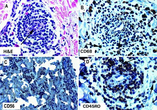 Fig. 4. Infiltration of immune effector cells at DTH reaction sites at 48 h. Immunohistochemical staining for immune effector cell antigens was accomplished as described in in “Materials and Methods.” A, vasculitis evident by H&E staining; B, CD68-positive macrophages; C, CD56-positive natural killer cells; D, CD45RO-positive T-cells. These photomicrographs are representative of postvaccination DTH cellular infiltrates against autologous prostate cell targets at both dose levels.