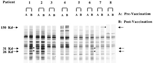 Fig. 5. Anti-PCA antibody responses induced by vaccination. Patient sera were used to probe immunoblots containing electrophoretically separated LNCaP polypeptides as described in “Materials and Methods.” Lanes A, immunoblots probed with patient sera obtained before vaccination; Lanes B, immunoblots probed with patient sera collected 2 weeks after administration of the final vaccine dose.