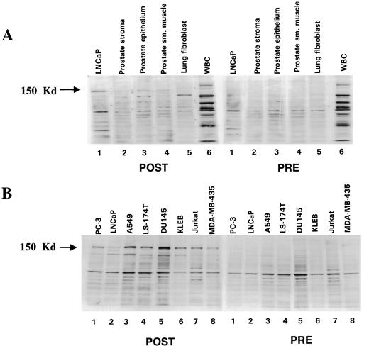 Fig. 6. Expression of a 150-kDa polypeptide recognized by serum from a vaccinated patient (patient 7; see Fig. 5<$REFLINK>). Immunoblots containing electrophoretically separated polypeptides from various cells were probed with serum recovered from patient 7 before (PRE) and after (POST) vaccination. A, Lane 1, LNCaP PCA cells; Lane 2, normal prostate stromal cells; Lane 3, normal prostate epithelial cells; Lane 4, normal prostate smooth muscle cells; Lane 5, normal lung fibroblasts; Lane 6, peripheral blood leukocytes. B, Lane 1, PC-3 PCA cells; Lane 2, LNCaP PCA cells; Lane 3, A549 lung carcinoma cells; Lane 4, LS-174T colon carcinoma cells; Lane 5, DU 145 PCA cells; Lane 6, KLE endometrial carcinoma cells; Lane 7, Jurkat T-cell leukemia cells; Lane 8, MDA-MB-435s breast carcinoma cells.