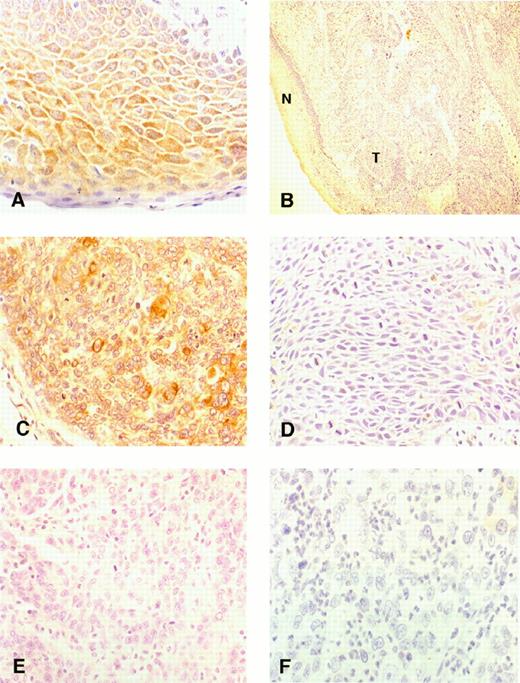 Fig. 1. Immunohistochemical staining of Fhit in normal and cancerous cervical epithelium. Immunohistochemical staining was performed in formalin-fixed, paraffin-embedded specimens as described in “Materials and Methods.” Data shown are: A, Fhit staining in the normal cervix, ×400; B, normal cervical epithelium (N) with absent Fhit staining in an underlying invasive squamous cell cervical cancer (T), ×200; C, normal Fhit staining in an invasive squamous cell cervical cancer, ×400; D, reduced Fhit staining in an invasive squamous cell carcinoma of the cervix, ×400; E, absent Fhit staining in an invasive squamous cell carcinoma of the cervix, ×400; F, absent Fhit staining in an invasive adenocarcinoma of the cervix, ×400.