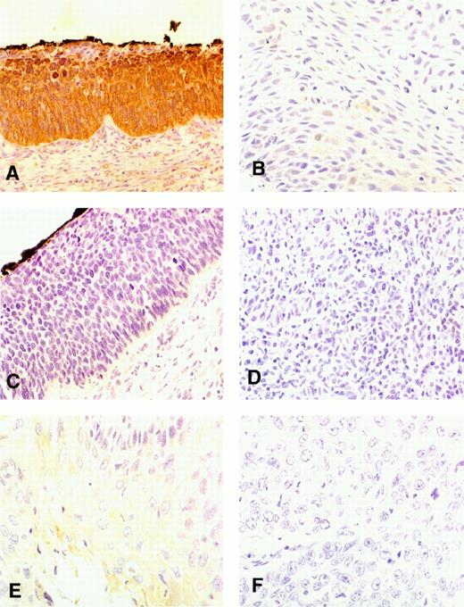 Fig. 2. Immunohistochemical staining of Fhit in preneoplastic lesions of the cervix and synchronous specimens from two cases. Immunohistochemical staining was performed as described in Fig. 1<$REFLINK>. Data shown are: A, normal Fhit staining in a HGSIL, ×300; B, reduced Fhit staining in an HGSIL, ×400; C, absent Fhit staining in a HGSIL, ×400; D, absent Fhit staining in an invasive cancer found in the same case as B, ×400; E, normal Fhit staining in HGSIL, × 400; F, absent Fhit staining in an invasive cancer found in the same case as E.