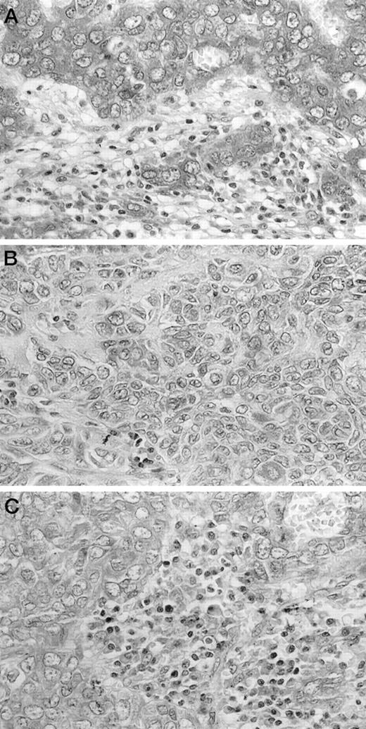 Fig. 4. Immunocytochemical staining of representative SCCHN tissues for expression of FasL (A and B) or Fas (C). Note strong, uniform expression of FasL in A, but weak and uneven FasL expression in B. In C, note Fas+ mononuclear cells infiltrating the tumor. ×1500.