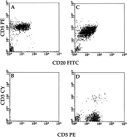 Fig. 1. Typical staining of T cells (CD3+CD5+) and tumor cells (CD20+CD5+CD3−) in PBMCs of B-CLL patients in early stage (A and B, patient 11) and advanced stage (C and D, patient 20).