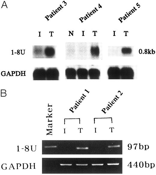 Fig. 1. A, expression of 1-8U mRNA in macroscopically normal mucosa (N), mildly inflamed colon mucosa (I), and UC-associated cancer tissue (T) of patients 3–5. The predicted size of 1-8U mRNA was 0.8 kb. For the internal standard, GAPDH was used as a housekeeping gene. B, RT-PCR demonstrating 1-8U mRNA expression in UC-associated cancer tissues rather than in mildly inflamed colonic mucosa in patients 1 and 2. The predicted size of RT-PCR products of 1-8U was 97 bp.