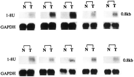 Fig. 2. Expression of 1-8U mRNA in sporadic colon cancer tissues. Ten representative samples of 1-8U mRNA expression in normal colon mucosa (N) and colon cancer tissues (T) from the same patients are shown.