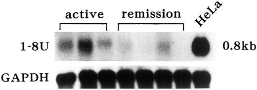 Fig. 5. Expression of 1-8U mRNA in severely inflamed colonic mucosa and in remission stage mucosa from UC patients without colitis-associated colon cancer. Three representative samples of severely inflamed colonic mucosa and four samples of 1-8U mRNA expression in remission stage mucosa from UC patients were shown. HeLa was used as a positive control.