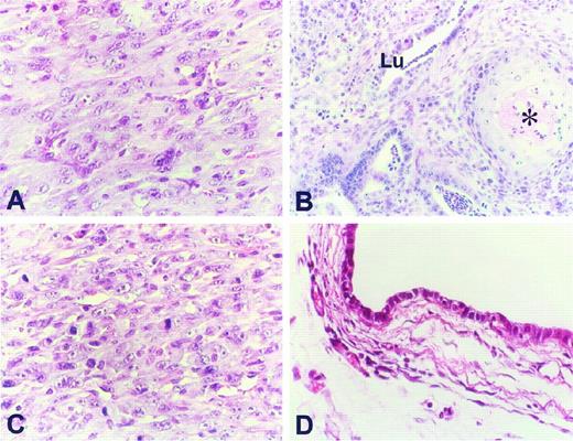 Fig. 3. Digitized light micrographs of xenografts from Msh2−/− p53−/− and p53−/− colonocytes. A, poorly differentiated adenocarcinoma in Msh2−/− p53−/−-induced xenografts at passage 26. B, adenosquamous carcinoma in p53−/−-induced xenograft at passage 49. Notice the presence of well-developed lumina (Lu) and of a keratin pearl (⋆). C, MMS-treated Msh2−/− p53−/− tumor xenograft at passage 12. D, xenograft from MMS-treated p53−/− colonocytes at passage 16. Notice the presence of a cyst lined by columnar epithelial cells and the absence of any malignancy. Images were digitized with a Pixera digital camera at resolution of ∼106 pixels/inch
