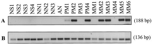 Fig. 4. A, nested RT-PCR of CTp11 expression (188 bp) on RNA isolated from samples of normal human skin and on RNA isolated from tissue samples containing lesions with different stages of melanocytic tumor progression (NS, normal skin; NN, common naevus naevocellularis; AN, atypical naevus; PM, primary melanoma; MM, melanoma metastasis). B, control RT-PCR of β2-microglobulin.