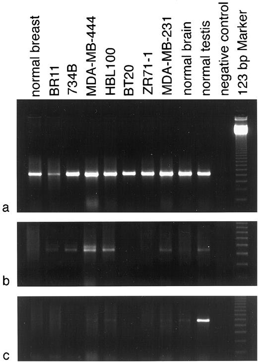 Fig. 3. Tissue expression of the different ING1 transcripts analyzed by RT-PCR. Variant A (a) is uniformly expressed in all normal tissues (breast, brain, and testis) and in all six breast cancer cell lines (734B, MDA-MB-468, HBL100, BT20, ZR71-1, and MDA-MB-231). Signal intensity is weaker in BR11, which may or may not reflect the expression level in the cancer cells because of normal stromal elements in the specimen. Variant B (b) is weakly expressed in BR11, four breast cancer cell lines (734B, MDA-MB-468, HBL100, and MDA-MB-231), and in normal testis and brain. Normal breast and two other breast cancer cell lines showed no visible signal by ethidium bromide staining. Strong expression of variant C (c) is only seen in normal testis. All six breast cancer cell lines were negative.