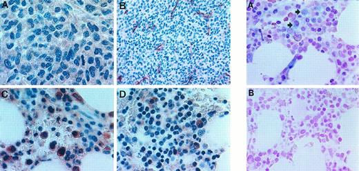 Fig. 7. (Left panels.) Immunohistochemical analysis of VEGF expression in human multiple myeloma. A, VEGF expression within the tumor mass (brown staining, ×1000); B, tumor mass revealing factor VIII-related, antigen-positive endothelial cells (brown staining, ×400); C, expression of Flt-1 within normal marrow cells (×1000); D, expression of KDR within normal marrow cells (×1000).