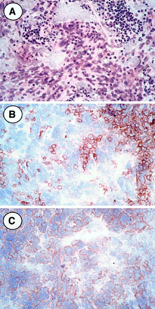 Fig. 2. CD95 staining on tissue sections of NPC biopsies. Photomicrographs of three cryostat sections of the biopsy of patient 2. A, stained with H&E. B, stained with anti-CD45 (Leukocyte Common Antigen), showing the distribution of tumor-infiltrating lymphocytes. C, anti-CD95 (UB2) which stains membranes of malignant epithelial cells. Magnification: A and B, ×200; C, ×400.