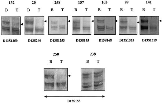 Fig. 2. Representative tumors studied for allelic deletion. In each case, tumor (T) and matched blood DNA (B) are shown in adjacent lanes. LOH is highlighted by the arrow. The microsatellite markers are shown below the tumor specimen. The figure also shows two invasive tumors in which the intragenic marker to RB1 (D13S153) is lost (#250) and one (#238) in which the marker is retained. LOH is demonstrated by the absence, or substantially reduced intensity, of one of the expected alleles in tumor DNA when compared with matched leukocyte DNA.