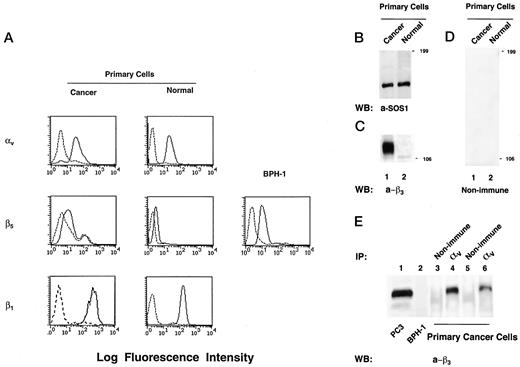 Fig. 5. Differential expression of β3 integrin in epithelial cells derived from human adenocarcinoma or normal prostate. A, FACS analysis of epithelial cells obtained from adenocarcinoma or normal tissue was performed using monoclonal antibodies against human αv or β5 or β1 integrins. BPH-1 cells were used as positive control for the antibody against β5. Primary epithelial cell lysates from either tumor (B–D, Lane 1) or normal (B–D, Lane 2) tissue specimens were separated using a 7.5% SDS-PAGE, and immunoblotting was performed using serum against the β3 integrin (C), nonimmune serum (D), or an antibody against SOS-1 (B); the last was used as control for protein loading. E, association of αv and β3 integrin subunits was shown by immunoprecipitation using serum against αv (Lanes 4 and 6), followed by immunoblotting using serum against β3. Nonimmune rabbit serum was used in immunoprecipitations as a negative control (Lanes 3 and 5). Two independent primary epithelial cell populations (Lanes 3 and 4 and Lanes5 and 6, respectively) isolated from tumor specimens are shown. Total lysates from PC3 (Lane 1) or BPH-1 (Lane 2) cells were used as positive and negative controls for β3 integrin expression, respectively.