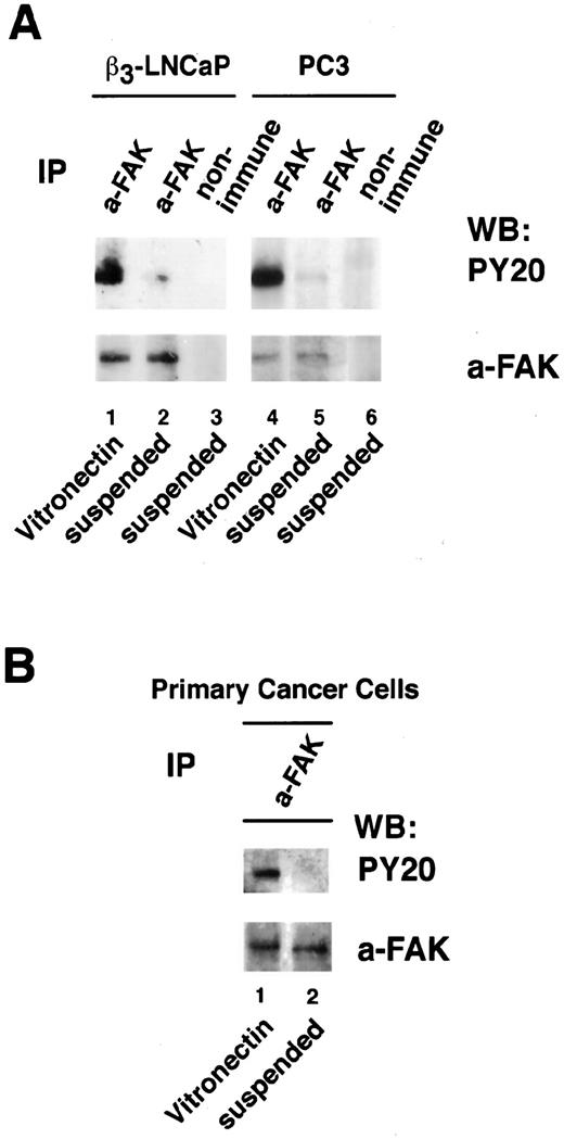 Fig. 6. αvβ3 engagement by VN stimulates FAK phosphorylation. A, β3-LNCaP or PC3 cells were plated on VN (Lanes 1 and 4; 3 μg/ml) or held in suspension (Lanes 2, 3, 5, and 6) for 45 min and lysed; β3-LNCaP (500 μg) or 200 μg PC3 lysate/immunoprecipitation were used. B, primary epithelial cells from prostatic adenocarcinoma were plated on VN (Lane 1; 3 μg/ml) or held in suspension (Lane 2) for 70 min and lysed; lysate (300 μg)/immunoprecipitation were used. A and B, anti-FAK immunoprecipitates were separated by 7.5% SDS-PAGE under reducing conditions and immunoblotted using PY20, antiphosphotyrosine monoclonal (top), and C-20, anti-FAK polyclonal antibody (bottom).