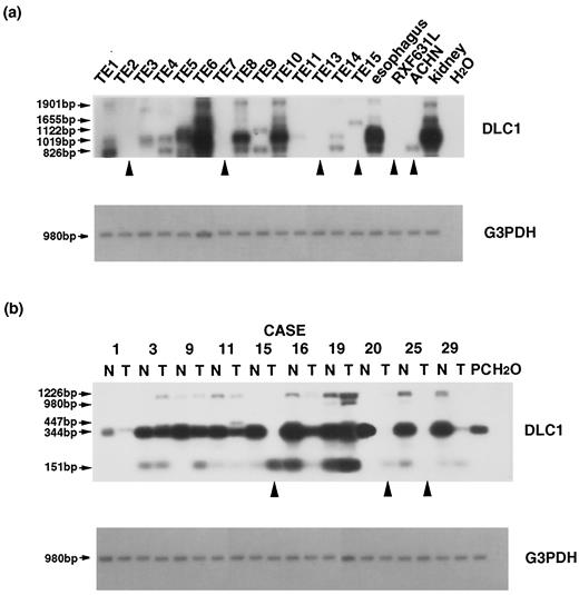 Fig. 4. a, RT-PCR analysis of the DLC1 transcript in various carcinoma cell lines. Primers allowed amplification from exons 12–14; glyceraldehyde-3-phosphate dehydrogenase (G3PDH) amplification served as a control for cDNA quality. Arrowheads, cancer materials that produced no detectable normal transcripts. b, RT-PCR analysis of the DLC1 transcript in lung cancers and adjacent normal tissues. Primers allowed amplification from exons 12 to 19. T and N, samples of tumor tissue and adjacent normal tissue, respectively; PC, positive control.