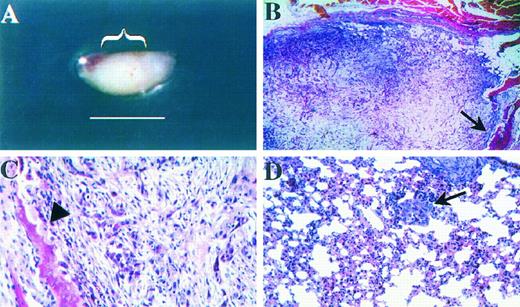 Fig. 2. Circulating cell colonization assay. Representative tumor formed in SCID-hu mouse after i.v. injection of PC3 cells. A, gross appearance of tumor in human bone fragment. Tumor appeared as a smooth mass (bracket) extending from residual normal bone tissue. Bar, 1 cm. B, low power view of tumor mass, showing residual bone tissue at the periphery (arrow). ×20. C, close examination revealed cohesive nests of tumor cells in a desmoplastic stromal response. Evidence of osteolytic activity could also be seen (arrowhead). ×100. D, representative colony of PC3 tumor cells in mouse lung, consisting of a small number of cells (arrow). ×100.