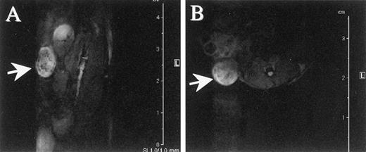 Fig. 3. MRI. T2-weighted spin echo MR images (TE = 60 ms, TR = 1225 ms) of a mouse bearing a PC3 tumor in implanted human bone tissue. A, coronal section, B, axial section. Arrows, tumor location.