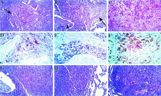 Fig. 4. End organ growth assay. Representative photomicrographs demonstrating histological features of tumors formed in human bone tissue (A-F) and human lung tissue (G-I) 6 weeks after the direct injection of human prostate cancer cell lines. A, DU145 cells formed solid tumors with evidence of osteolytic activity (arrow). ×100. A mild desmoplastic stromal response was visible in some areas of bone tumors and was revealed by red staining of tumor cells with a pancytokeratin antibody (D). ×200. B, bone tumors formed by LNCaP also showed a desmoplastic stromal response, and evidence of both osteoblastic (arrow) and osteolytic activity (arrowhead) could be seen by routine staining. ×100. E, the intermingling of red-stained LNCaP cells and stromal cells could be better seen after cytokeratin immunostaining. ×200. C, PC3 cells formed solid osteolytic tumors, and bone tissue was often completely destroyed. ×100. A strong desmoplastic stromal response was visible in these tumors, revealed both by routine H&E staining (C) and by red staining for cytokeratin (F). ×200. DU145, LNCaP, and PC3 cell lines all formed small solid tumors in human lung tissue and demonstrated little stromal-epithelial interaction (G, H, and I, respectively). ×100.