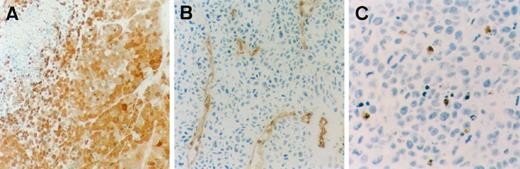 Fig. 6. A, TP staining in a KB/TP tumor, ×200. Immunohistochemical analysis of vascularization and apoptosis. B, microvessel staining with murine anti-CD31 monoclonal antibody (×200). C, apoptotic cells were detected in situ by labeling fragmented DNA with TUNEL (×400).